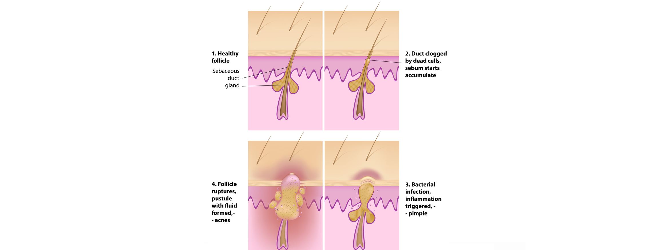 Formation of Skin Pimples and Acnes